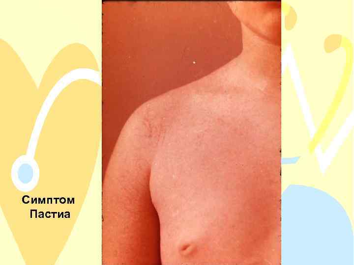 Симптом Пастиа 