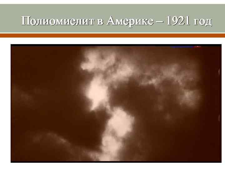 Полиомиелит в Америке – 1921 год 
