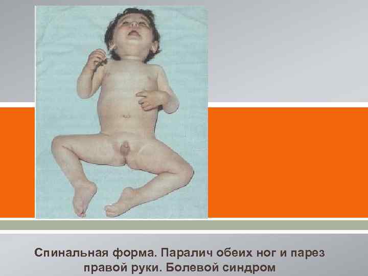 [ [ Спинальная форма. Паралич обеих ног и парез правой руки. Болевой синдром 