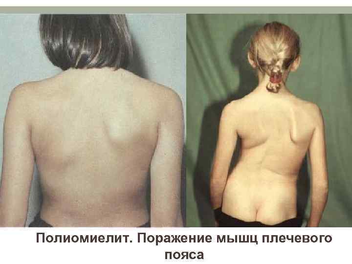 Полиомиелит. Поражение мышц плечевого пояса 