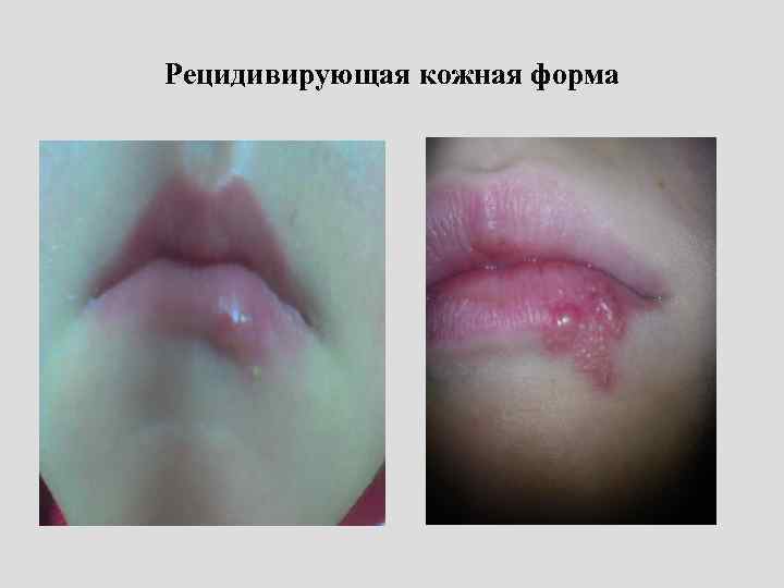 Рецидивирующая кожная форма 