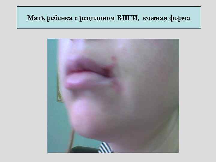 Мать ребенка с рецидивом ВПГИ, кожная форма 