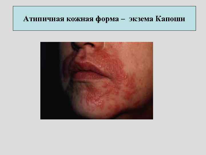 Атипичная кожная форма – экзема Капоши 