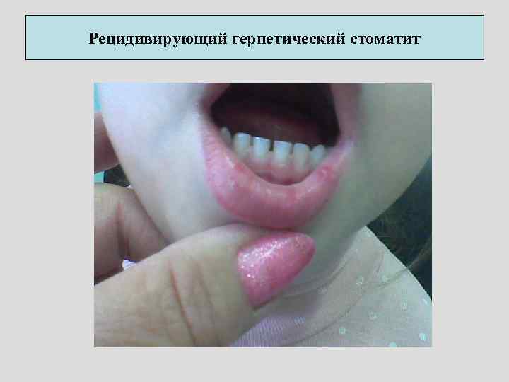 Рецидивирующий герпетический стоматит 