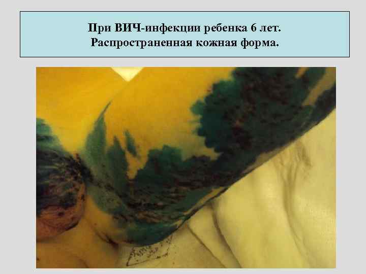 При ВИЧ-инфекции ребенка 6 лет. Распространенная кожная форма. 