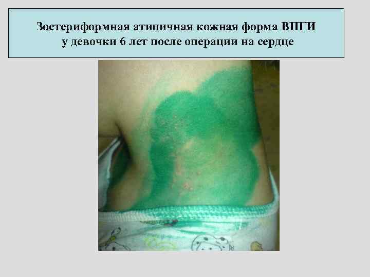 Зостериформная атипичная кожная форма ВПГИ у девочки 6 лет после операции на сердце 