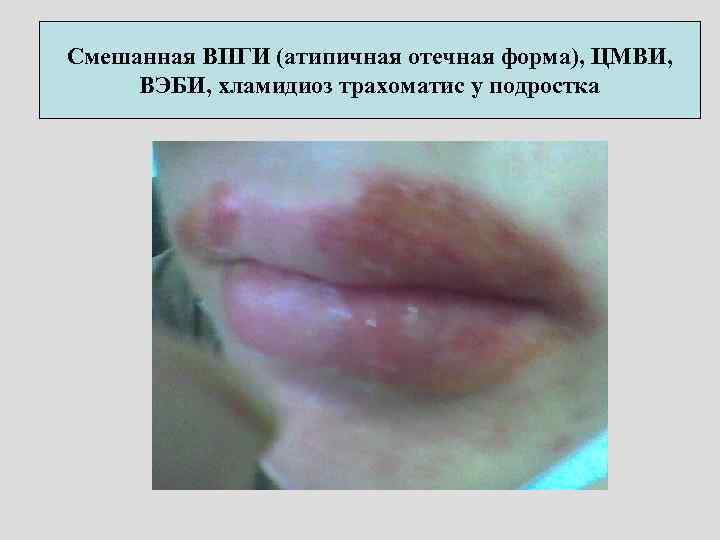Смешанная ВПГИ (атипичная отечная форма), ЦМВИ, ВЭБИ, хламидиоз трахоматис у подростка 