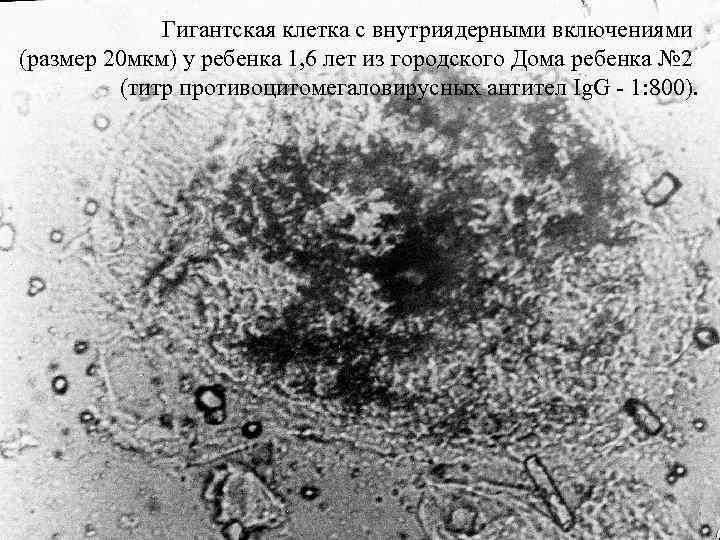 Гигантская клетка с внутриядерными включениями (размер 20 мкм) у ребенка 1, 6 лет из