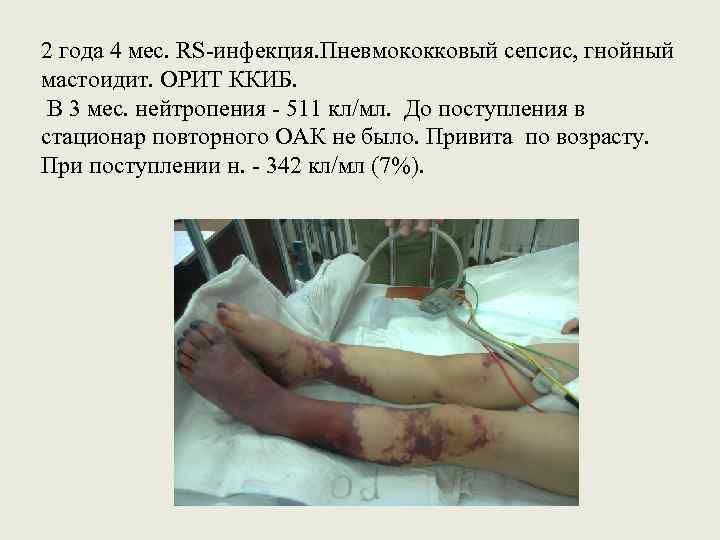 2 года 4 мес. RS-инфекция. Пневмококковый сепсис, гнойный мастоидит. ОРИТ ККИБ. В 3 мес.