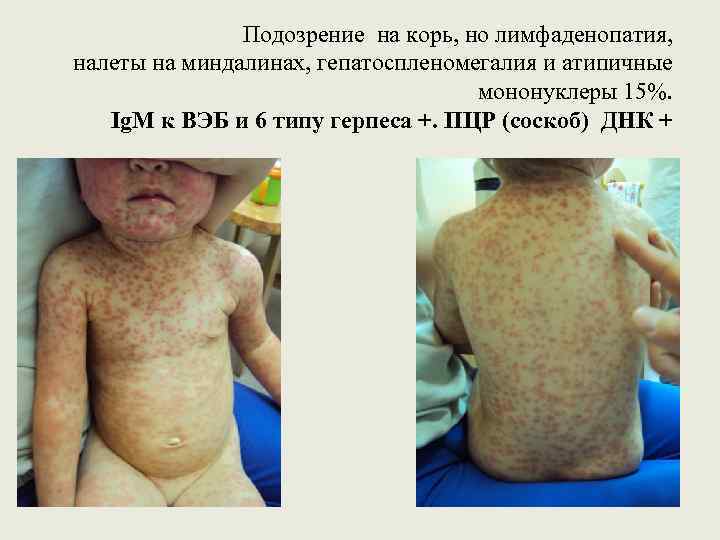 Подозрение на корь, но лимфаденопатия, налеты на миндалинах, гепатоспленомегалия и атипичные мононуклеры 15%. Ig.