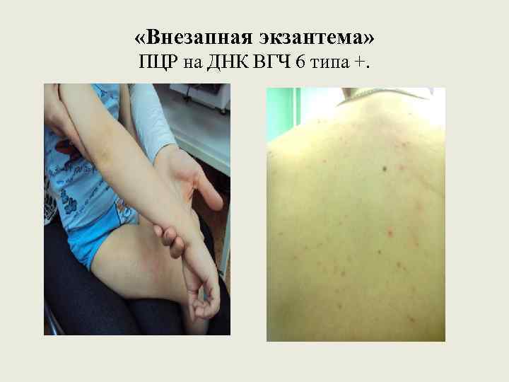  «Внезапная экзантема» ПЦР на ДНК ВГЧ 6 типа +. 