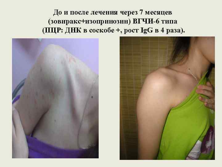 До и после лечения через 7 месяцев (зовиракс+изопринозин) ВГЧИ-6 типа (ПЦР: ДНК в соскобе