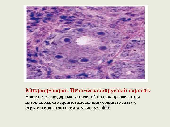 Микропрепарат. Цитомегаловирусный паротит. Вокруг внутриядерных включений ободок просветления цитоплазмы, что придает клетке вид «совиного