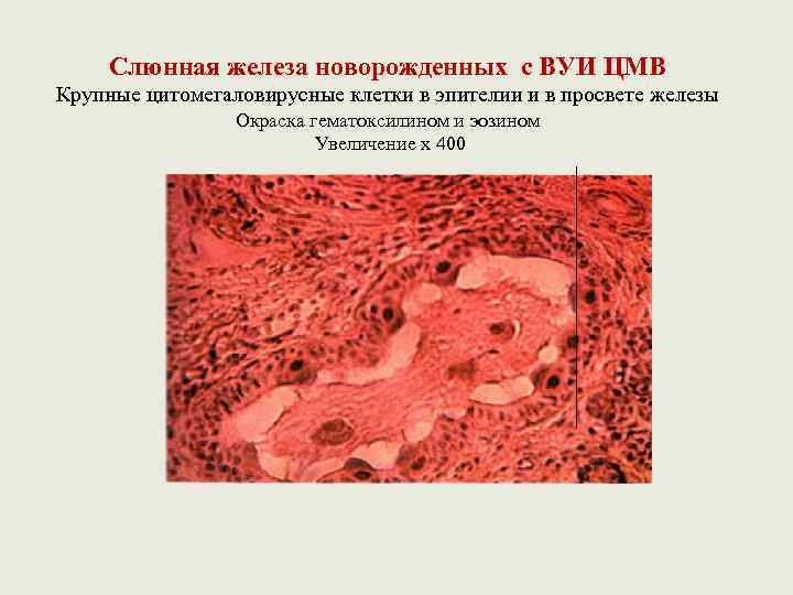 Слюнная железа новорожденных с ВУИ ЦМВ Крупные цитомегаловирусные клетки в эпителии и в просвете