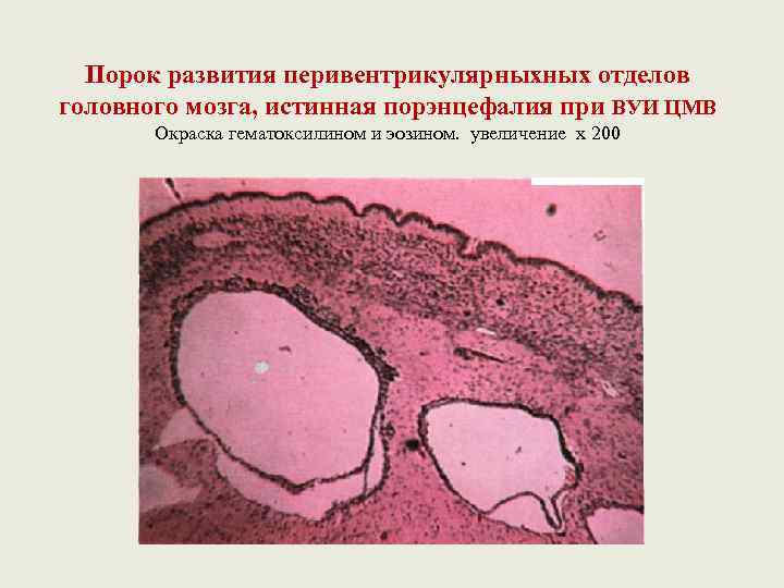 Порок развития перивентрикулярныхных отделов головного мозга, истинная порэнцефалия при ВУИ ЦМВ Окраска гематоксилином и