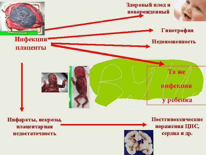 Здоровый плод и новорожденный Гипотрофия Инфекция плаценты Недоношенность Та же инфекция у ребенка Инфаркты,