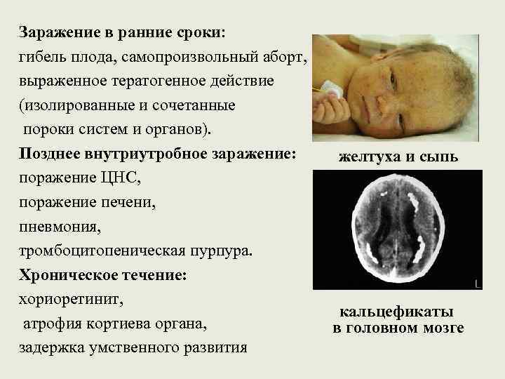 Заражение в ранние сроки: гибель плода, самопроизвольный аборт, выраженное тератогенное действие (изолированные и сочетанные