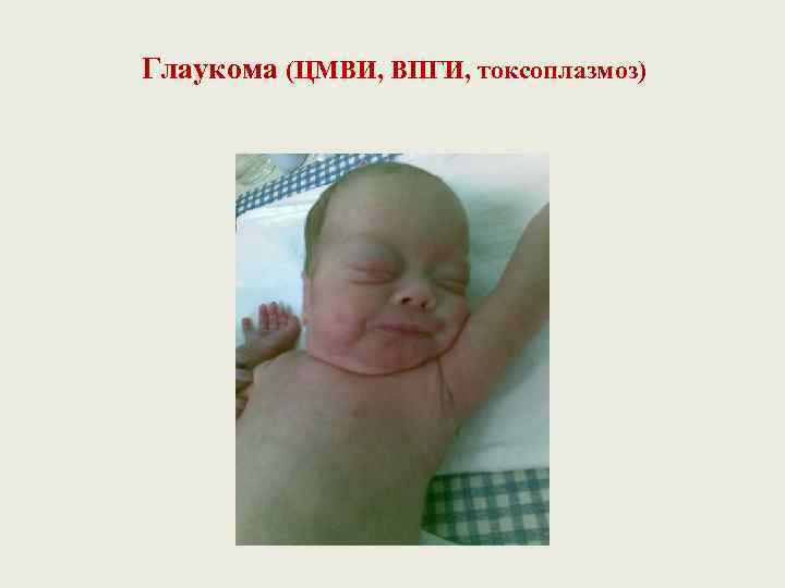 Глаукома (ЦМВИ, ВПГИ, токсоплазмоз) 