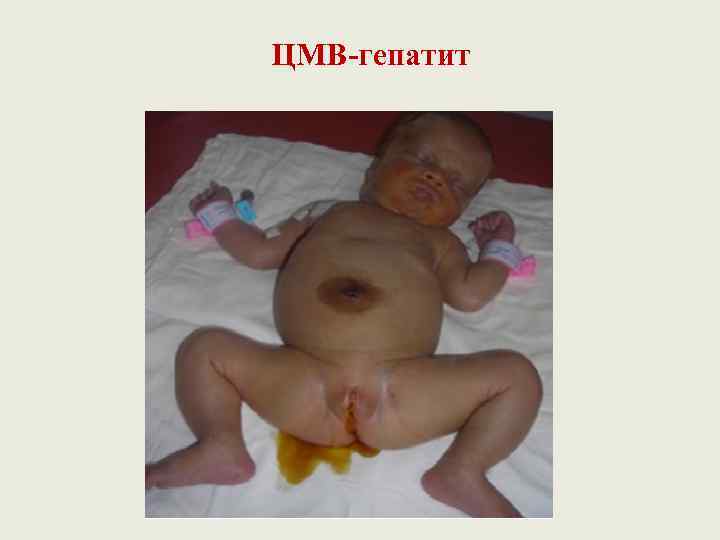 ЦМВ-гепатит 