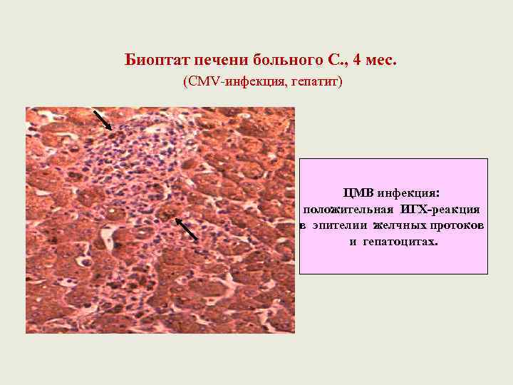 Биоптат печени больного С. , 4 мес. (CMV-инфекция, гепатит) ЦМВ инфекция: положительная ИГХ-реакция в
