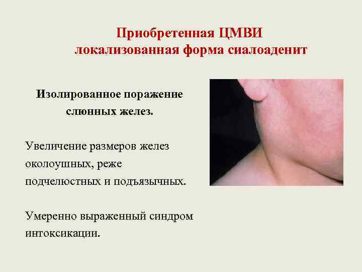 Приобретенная ЦМВИ локализованная форма сиалоаденит Изолированное поражение слюнных желез. Увеличение размеров желез околоушных, реже
