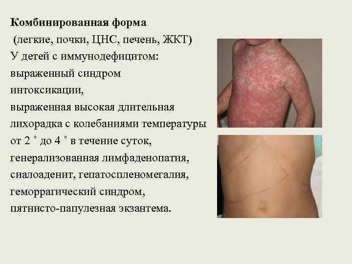 Комбинированная форма (легкие, почки, ЦНС, печень, ЖКТ) У детей с иммунодефицитом: выраженный синдром интоксикации,