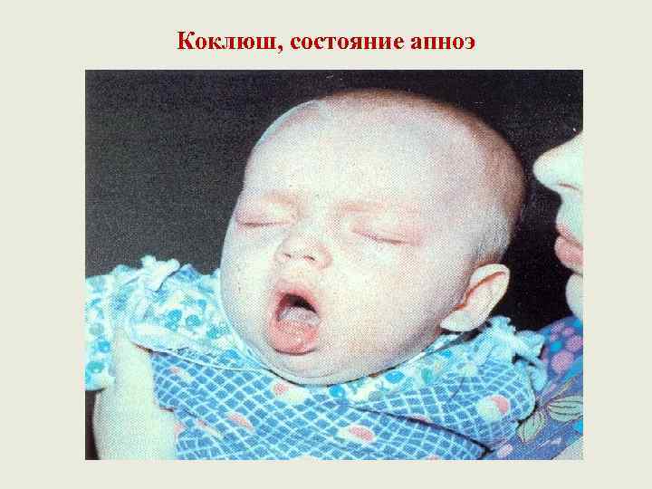 Коклюш, состояние апноэ 