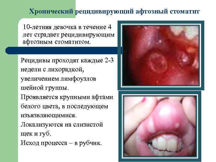 Хронический рецидивирующий афтозный стоматит 10 -летняя девочка в течение 4 лет страдает рецидивирующим афтозным