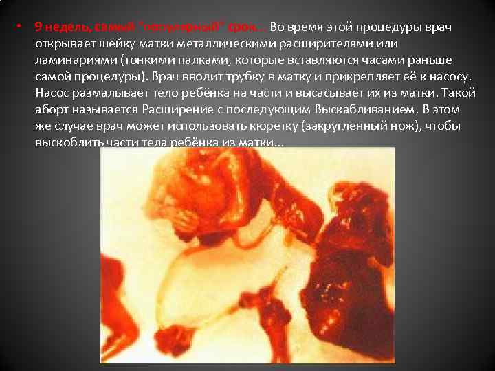  • 9 недель, самый "популярный" срок. . . Во время этой процедуры врач