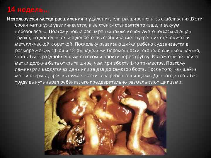 14 недель. . . Используется метод расширения и удаления, или расширения и выскабливания. В