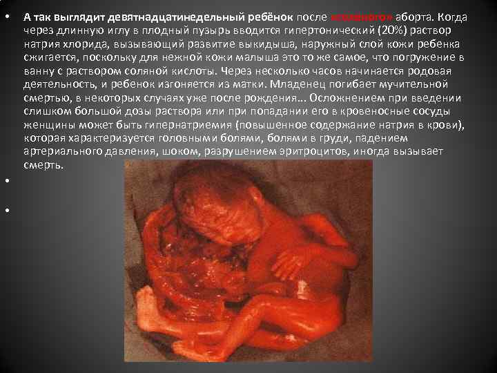  • • • А так выглядит девятнадцатинедельный ребёнок после «соленого» аборта. Когда через