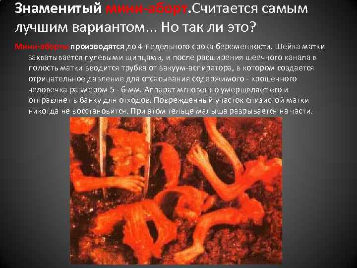 Знаменитый мини-аборт. Считается самым лучшим вариантом. . . Но так ли это? Мини-аборты производятся
