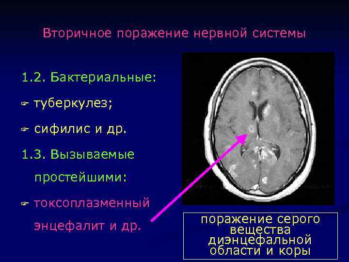 Демиелинизирующие поражения нервной системы. Демиелинизирующие заболевания нервной системы. Демиелинизирующие заболевания. Аксонально демиелинизирующее поражение нерва