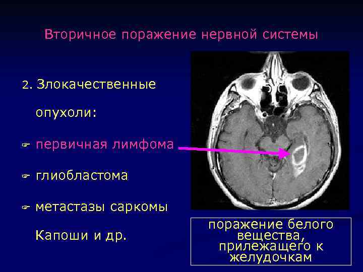 Признаки демиелинизирующего поражения