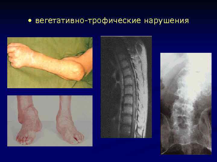  • вегетативно-трофические нарушения 
