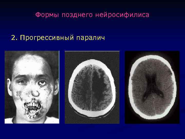 Формы позднего нейросифилиса 2. Прогрессивный паралич 