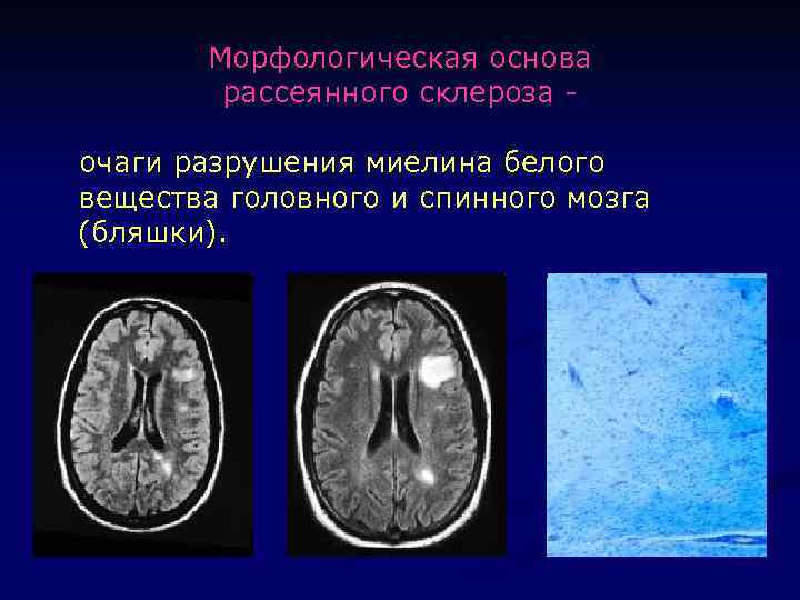 Сосудистый очаг в головном мозге что это. Очаги рассеянного склероза. Демиелинизирующие заболевания головного мозга. Очаги головного мозга демиелинизирующего характера. Бляшки рассеянного склероза.