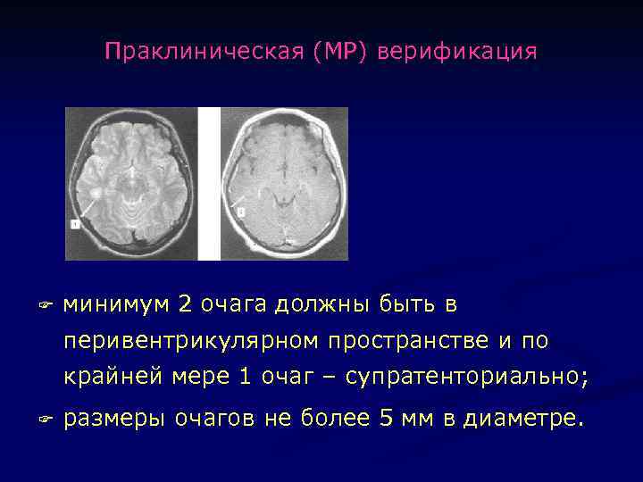 Мр картина единичных супратенториальных очагов