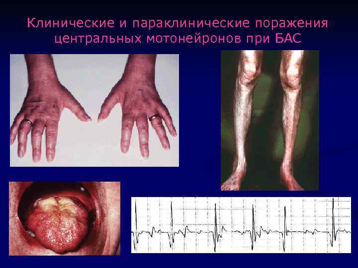 Клинические и параклинические поражения центральных мотонейронов при БАС 