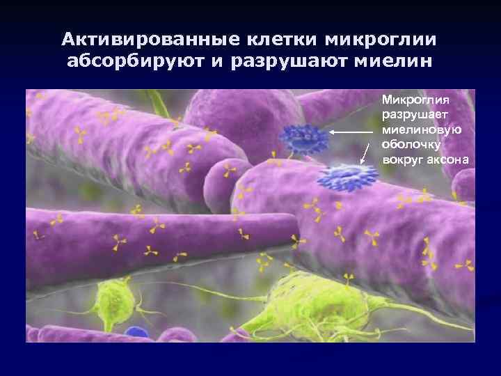 Активированные клетки микроглии абсорбируют и разрушают миелин Микроглия разрушает миелиновую оболочку вокруг аксона 