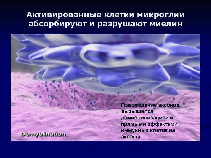 Активированные клетки микроглии абсорбируют и разрушают миелин Повреждение аксонов вызывается демиелинизацией и прямыми эффектами