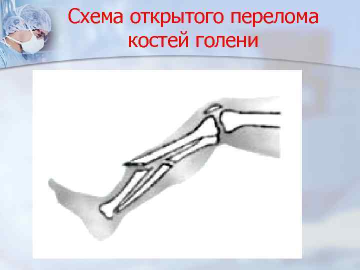 Клиника открытого перелома костей