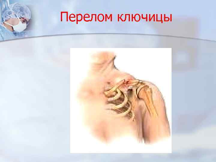 Перелом ключицы 