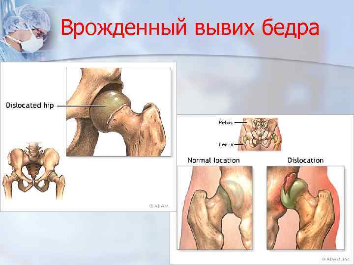 Врожденный вывих бедра 