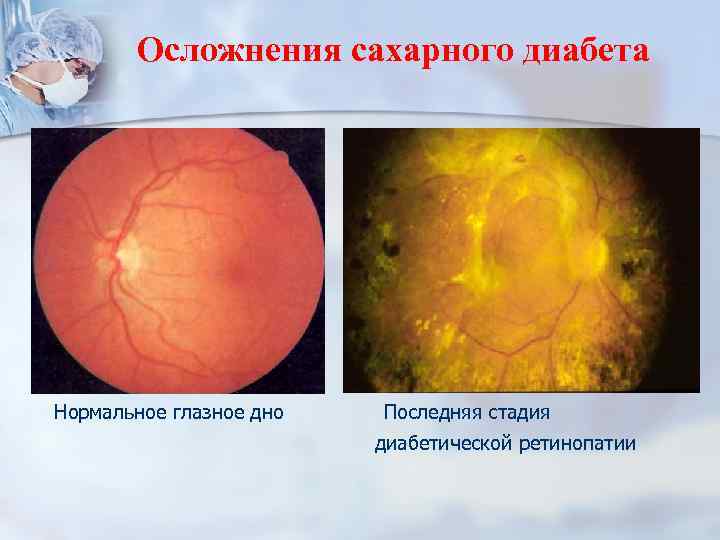 Осложнения сахарного диабета Нормальное глазное дно Последняя стадия диабетической ретинопатии 