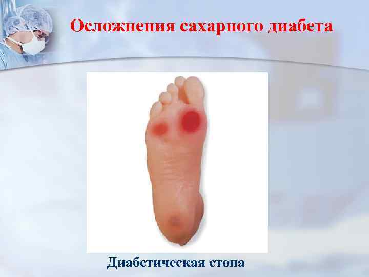 Осложнения сахарного диабета Диабетическая стопа 
