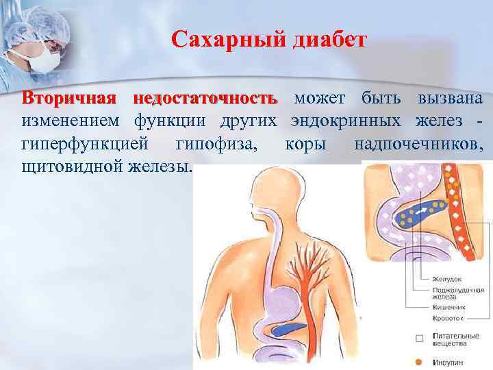Сахарный диабет Вторичная недостаточность может быть вызвана изменением функции других эндокринных желез гиперфункцией гипофиза,