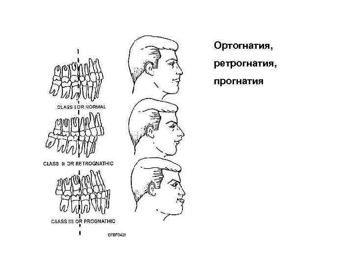 Prognathia латынь. Прогнатия и ретрогнатия. Ретрогнатия нижней челюсти. Прогнатия верхней челюсти. Ретрогнатия верхней и нижней челюсти что это.