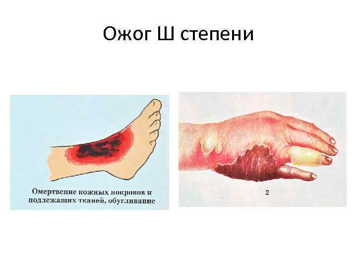 Ожог Ш степени 