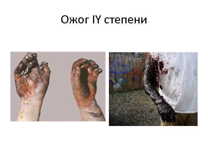 Ожог IY степени 